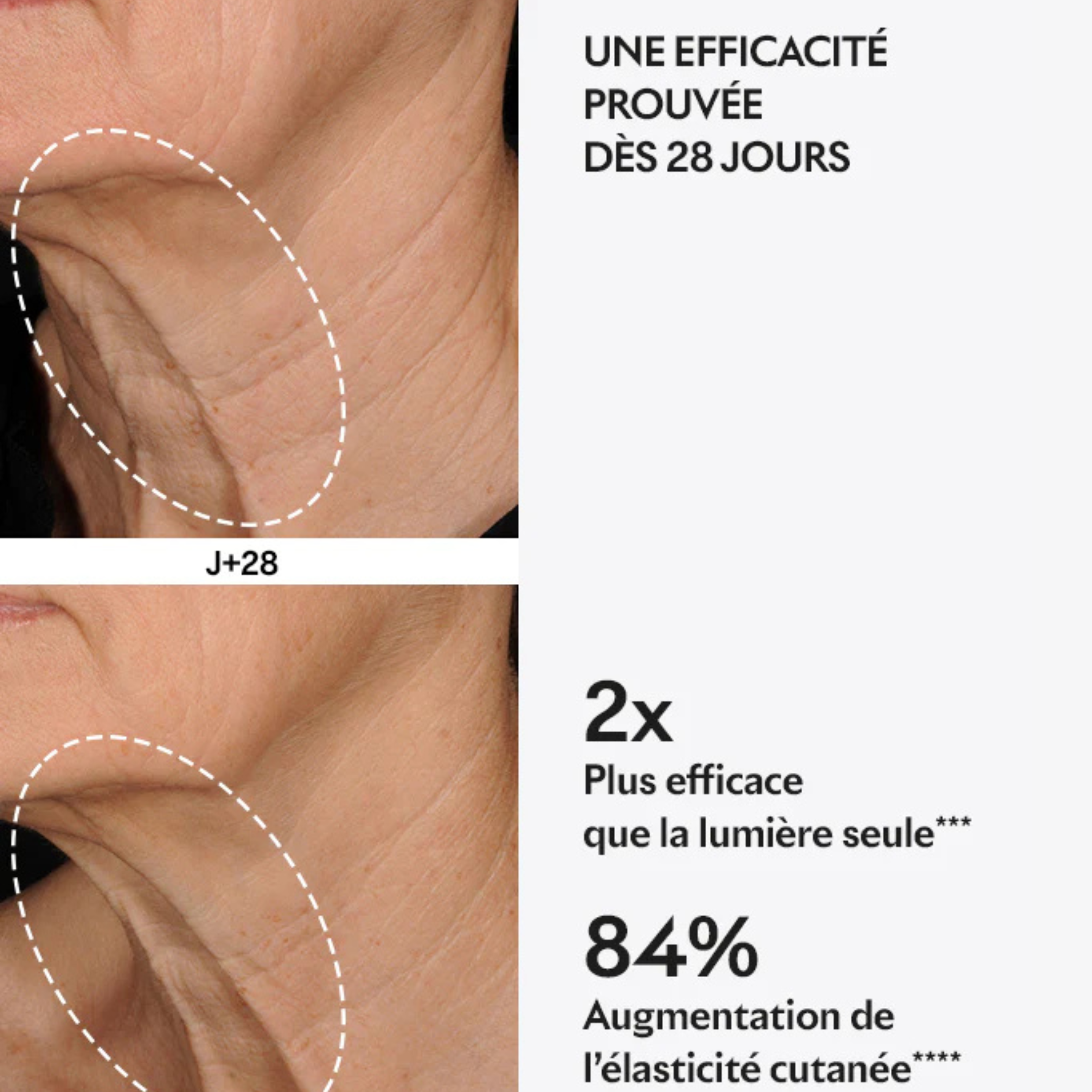 Large LIFT capsule pouch