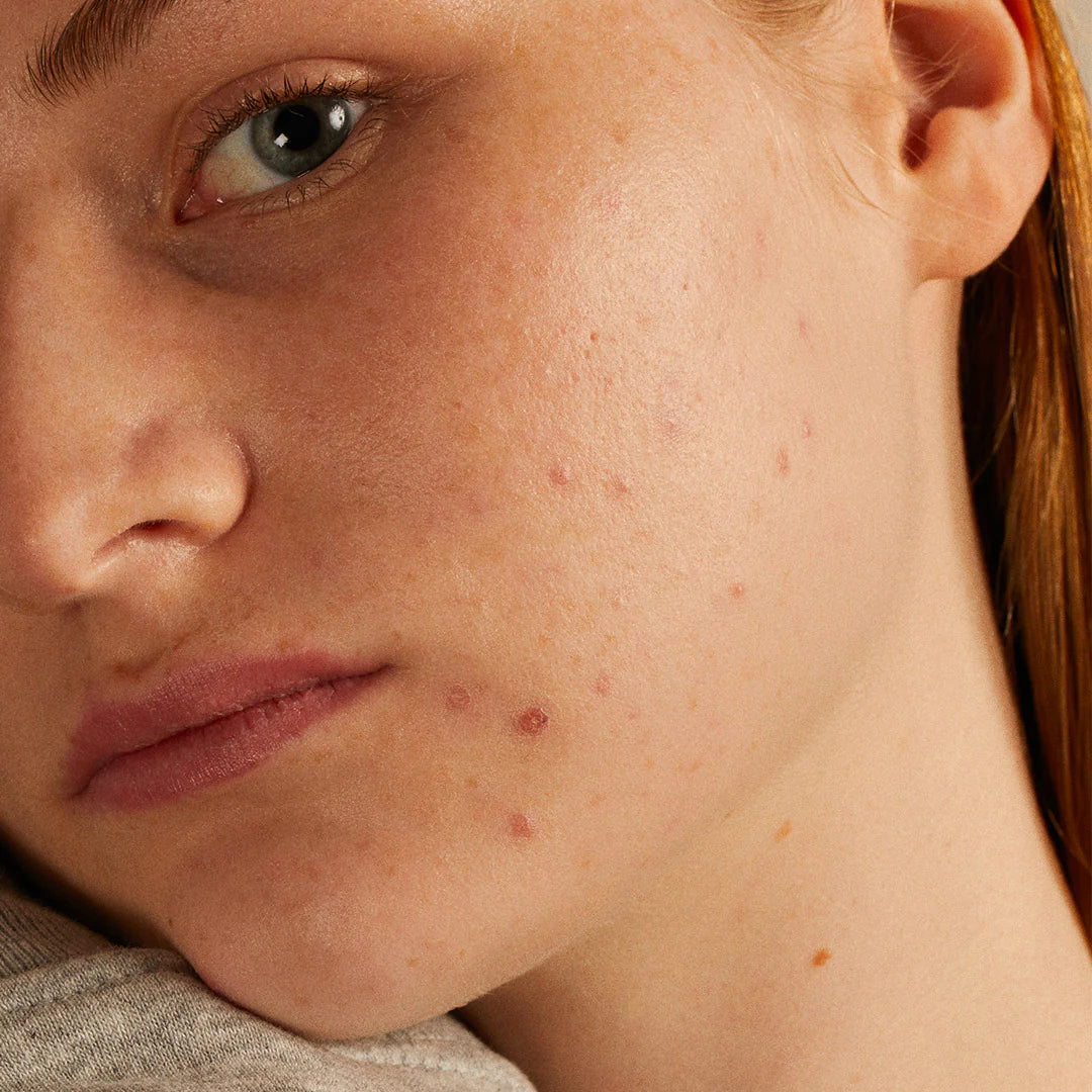 Minimum Routine for acne-prone skin